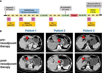 Case Report: Neoadjuvant PD-1 Blockade Plus Concurrent Chemoradiotherapy in Unresectable Locally Advanced Gastric Cancer Patients